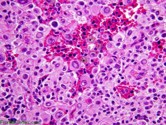 Primary Meningeal Melanoma, H&E stain x 400