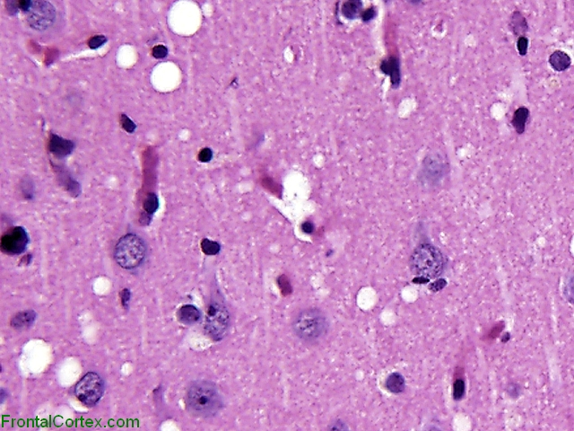 Sporadic Jakob-Creutzfeldt disease, stereotactic biopsy specimen, H&E stain x 400