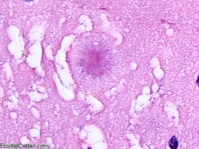 Variant Jakob-Creutzfeldt disease,  cerebral cortex, H&E stain x 400