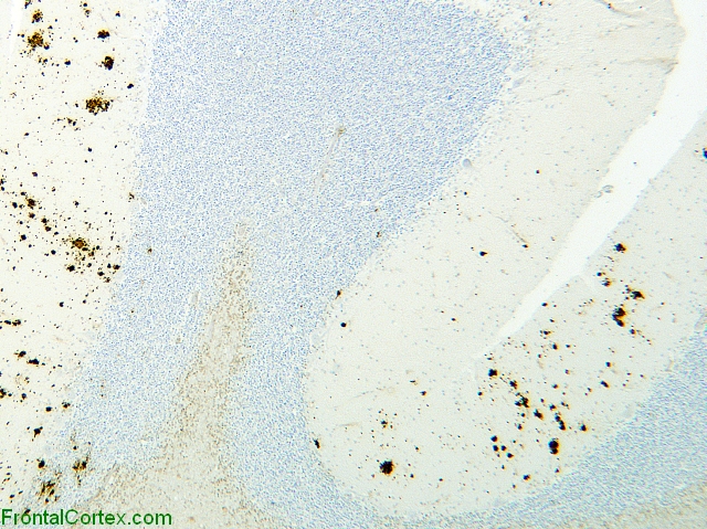 Familial prion disease, cerebellum, 3F4 immunohistochemical staining