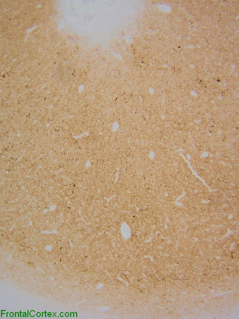 Prion IHC cerebrum