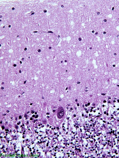 Prion MM1 cerebellum