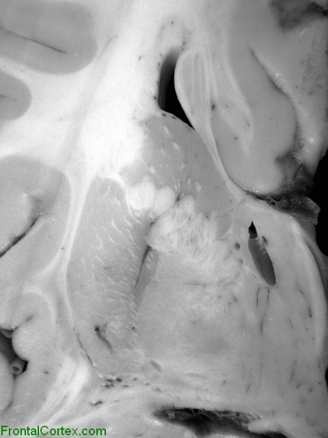 Agenesis of the corpus callosum, coronal section demonstrating Probst bundle