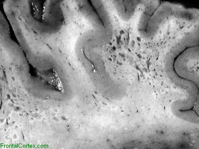 Progressive   Multifocal leukoencephalopathy, horizontal section of brain.