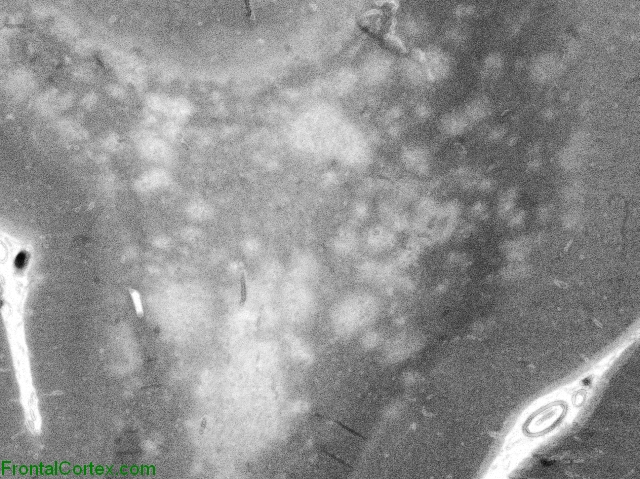 Progressive multifocal leukoencephalopathy, whole mount of myelin stain section.