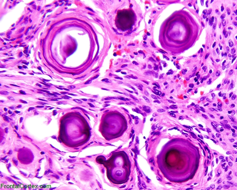 Psammomatous meningioma, H&E stain.