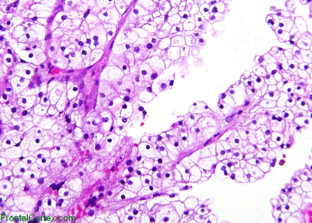 RCC met Pituitary