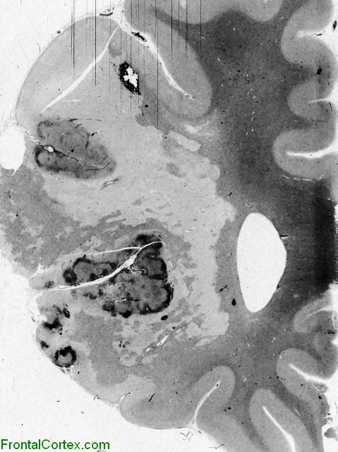 Recent middle cerebral artery infarct, whole mount coronal section through frontal lobe.