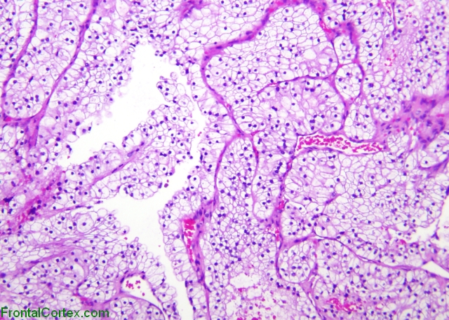 Renal Cell Ca Pit Met