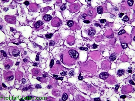 Rhabdoid Meningioma, high power H&E stained slide