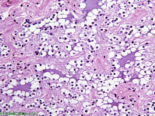 Rosetted Glioneuronal Tumor IVth Ventricle H&E