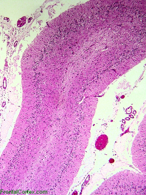 Spinocerebellar atrophy, H&E section through cerebellar folia x 40