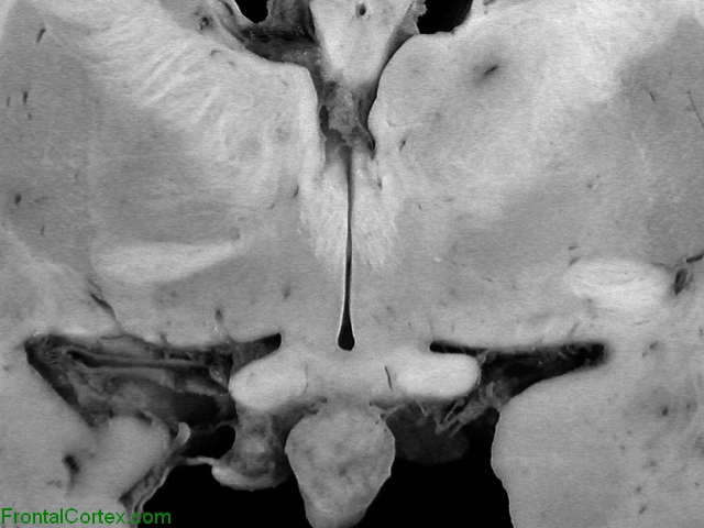 Neurosarcoidosis, coronal surface of brain at the level of the optic chiasm.