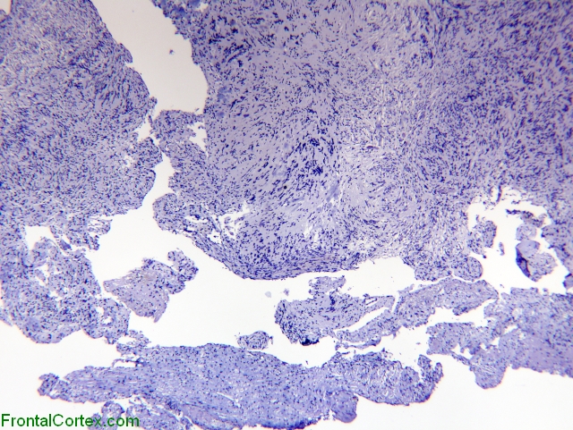 Schwannoma EMA