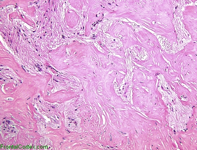 Sclerotic meningioangiomatosis, H&E stain x 100.