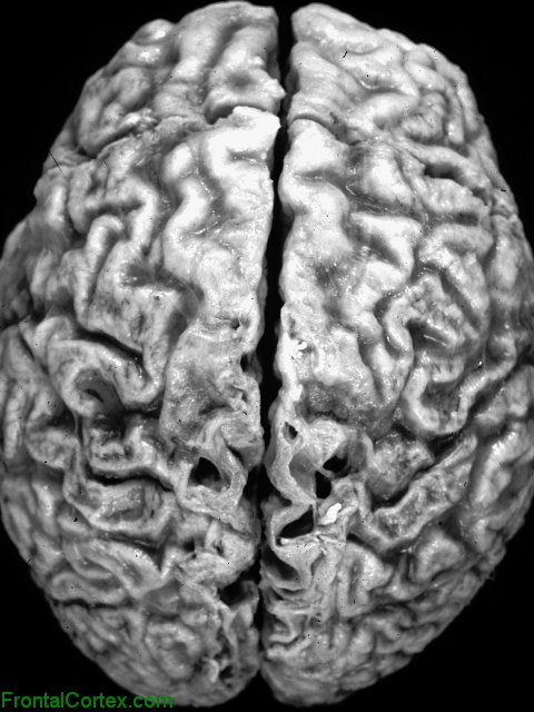 Alzheimer disease, dorsal surface of brain.