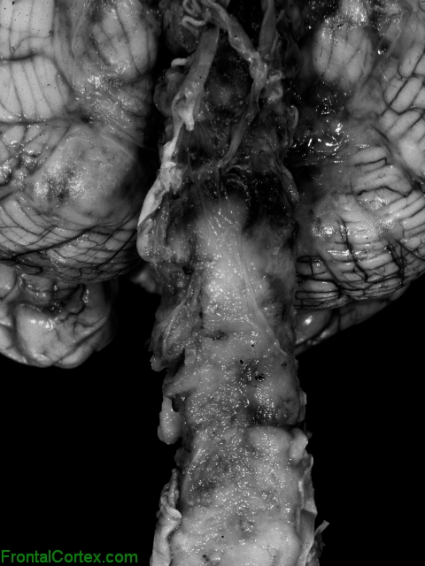 Glioblastoma multiforme involving cervical spinal cord, gross photograph.