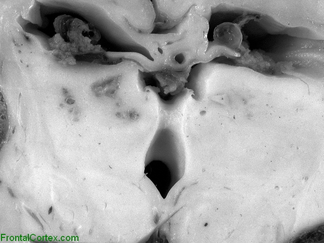 Multicystic encephalopathy with status marmoratus