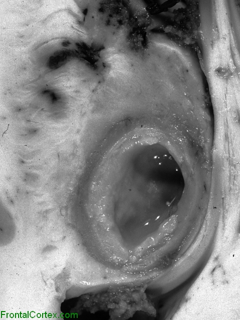 Thick-walled cavity containing sterile fluid, thalamus, hard frontal section, close-up