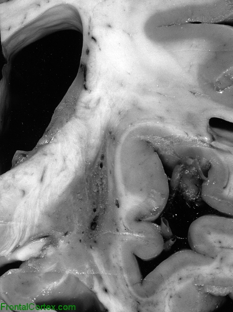 Striatonigral Degeneration Putamen Coronal