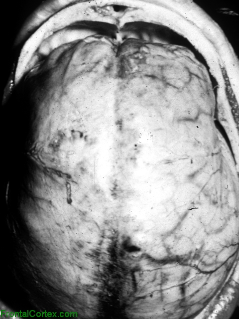 Subdural empyema, dorsal surface of brain, in situ photograph