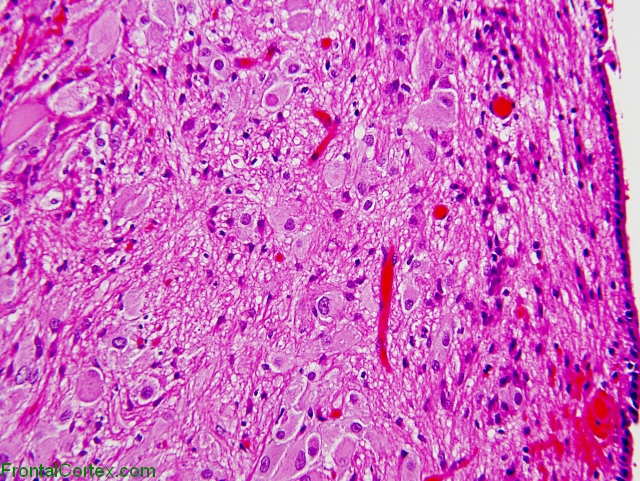 Subependymal giant cell astrocytomas