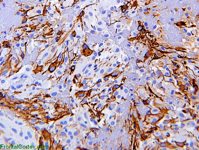 Subependymal Giant Cell Astrocytoma, GFAP immunohistochemical staining x 400