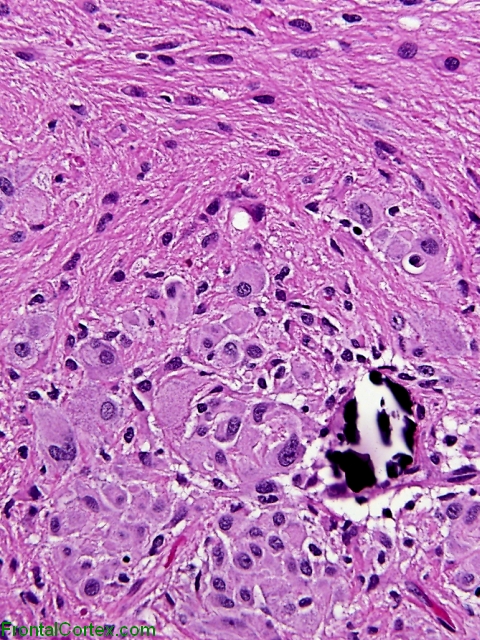 Subependymal Giant Cell Astrocytoma,   High power H&E stained section.