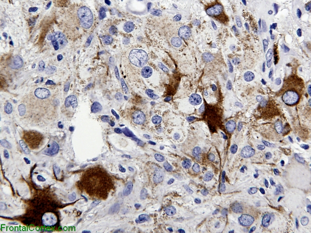 Subependymal Giant Cell Astrocytoma, Neurofilament immunohistochemical staining