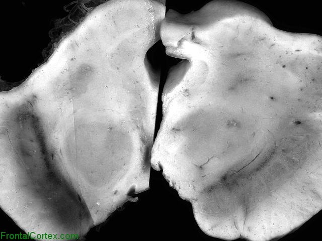 Substantia Nigra PD and Control