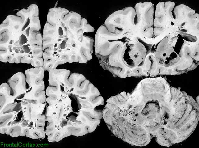 Swiss Cheese Coronal Multiple