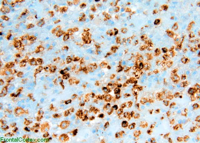 TLDL CD68 IHC