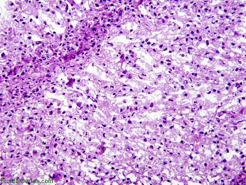 Tumefactive demyelination, frozen section preparation, H&E stain x 100