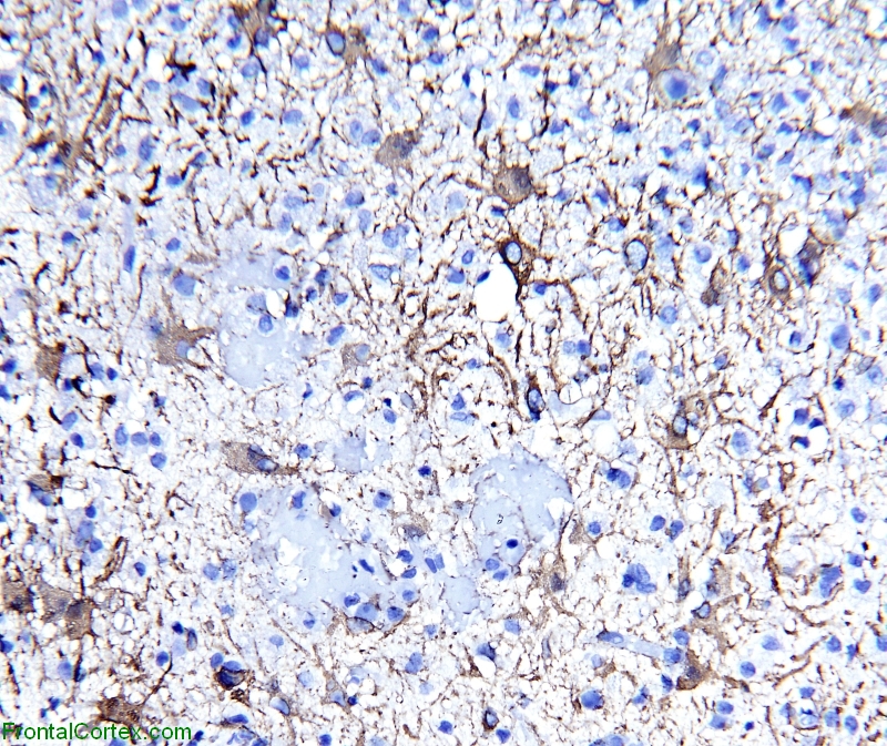 Tumefactive demyelinating lesion, GFAP immunohistochemical staining x 200