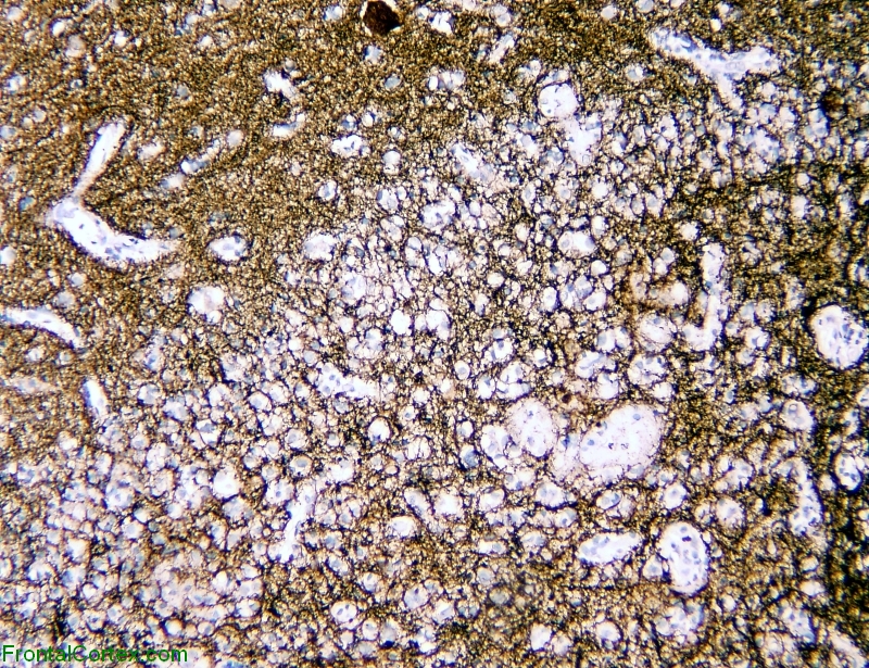 tumefactive demyelination, brain/lesion interface, neurofilament immunostaining x 100