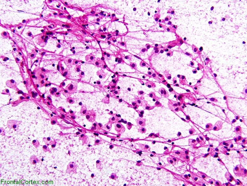 Tumefactive demyelination, intraoperative crush preparation x 200