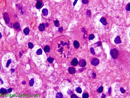 Tumefactive demyelination, Creutzfeldt-Peters cell