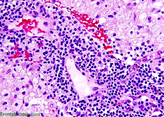 Tumefactive demyelination, high power H&E stained slide demonstrating perivascular inflammation