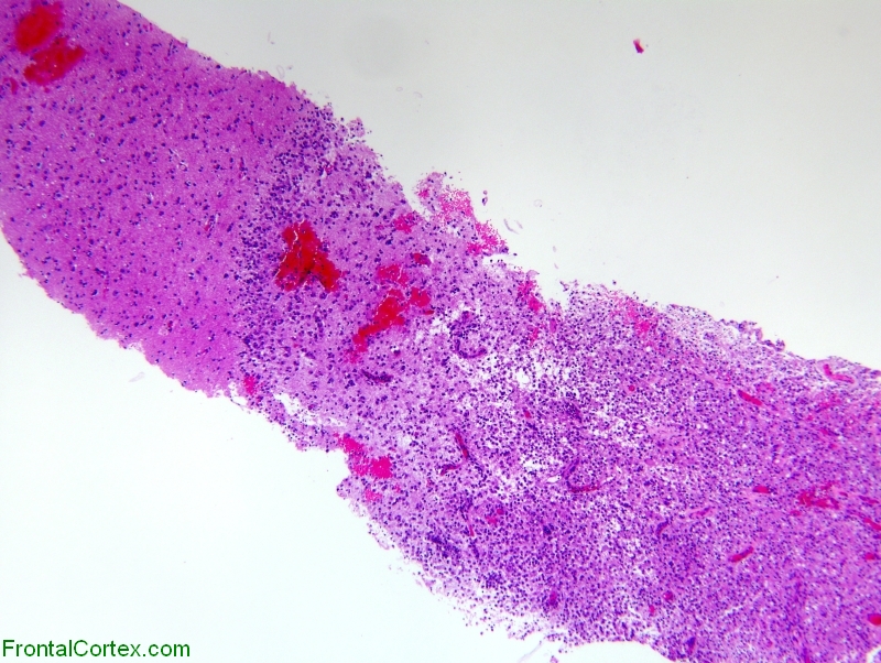 TLDL stereotactic 20x