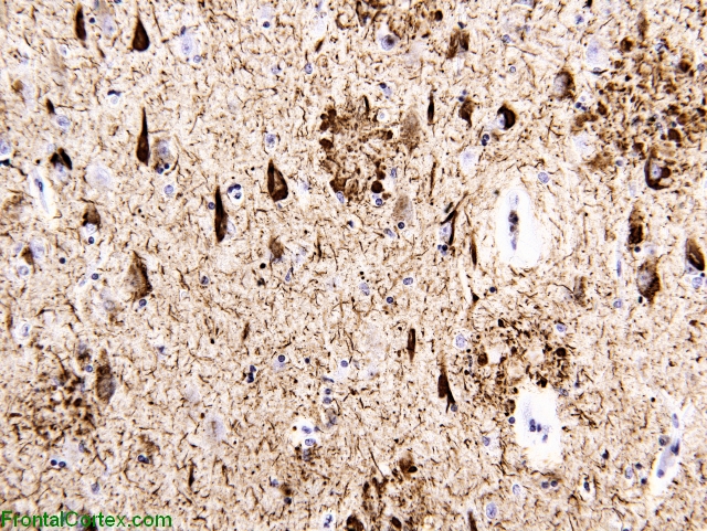 Alzheimer's disease, tau immunohistochemical stain, neocortex x 200