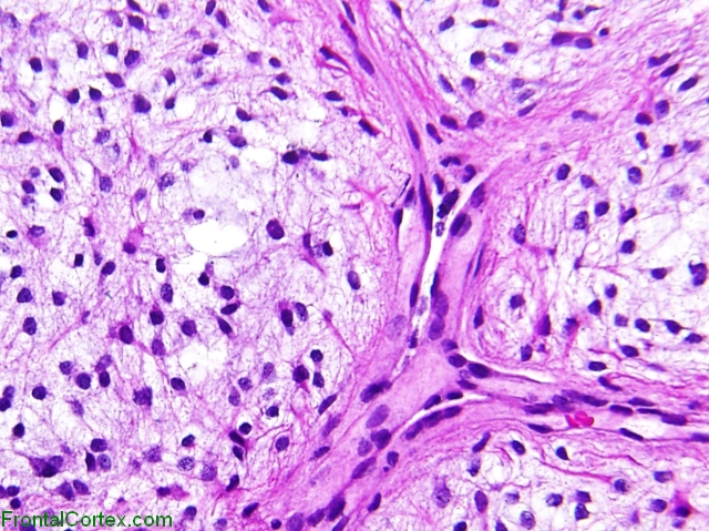 "Tectal Glioma", H&E stain x 200