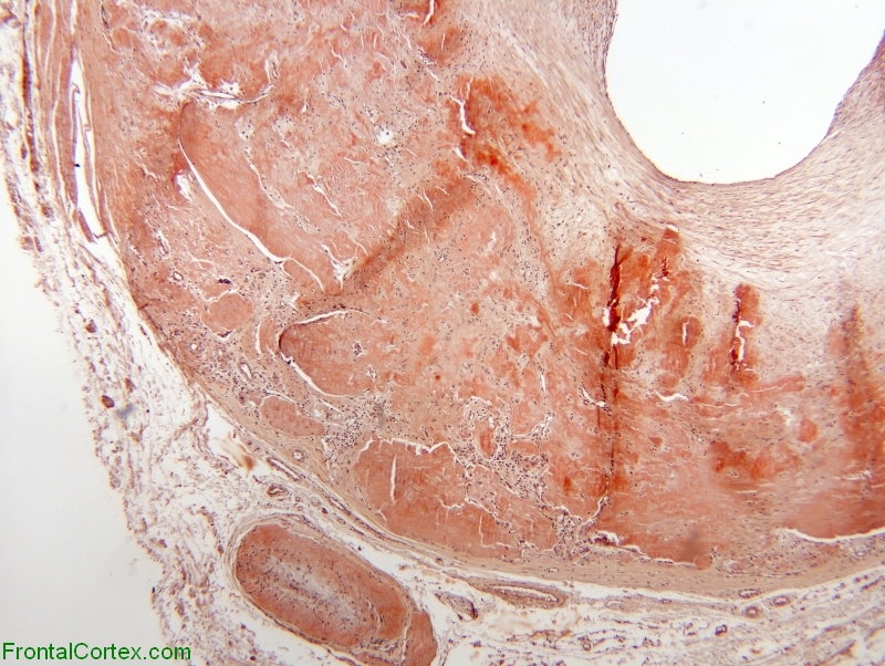 Temporal Artery, Congo Red stained section x 40