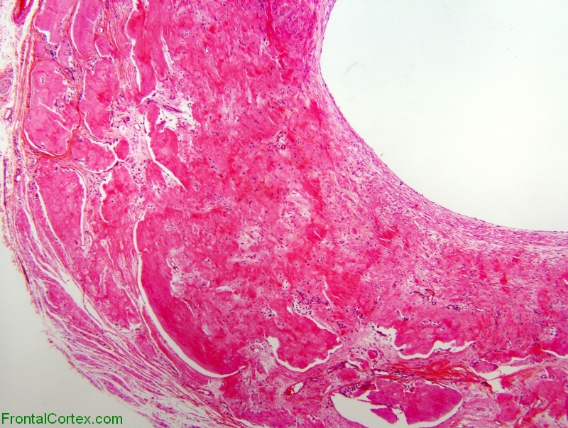 Temporal Artery with Amyloid, H&E stain x40