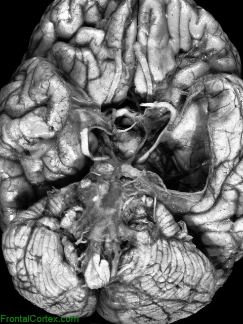 Temporal Lobe Arachnoid Cyst Ventral