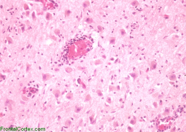 West nile virus encephalitis, thalamus, H&E stained section