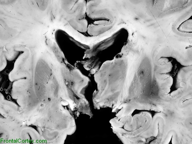 Thalamotomy for Parkinson Disease 1976 Coronal