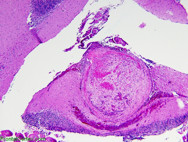 Thromboembolus, low power H&E stained section