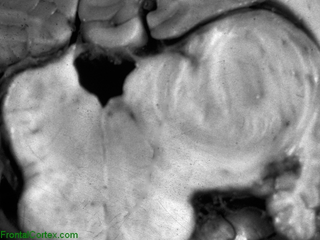 Tuberculoma, dorsal medulla, transverse section