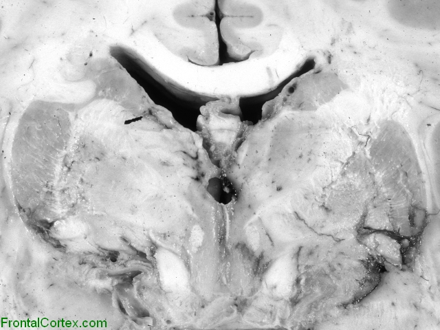 Tuberculous Meningitis Coronal