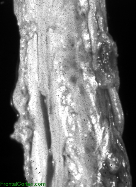 Tuberculous Spinal Meningitis